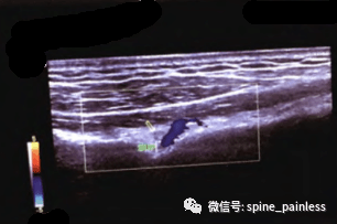 脊椎保养与除痛 | 顽固性肩部疼痛看过来